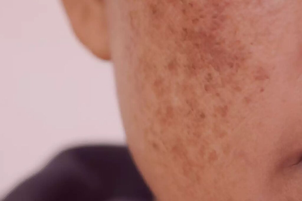O que é Melasma: Saiba tudo sobre Melasma e como tratar
