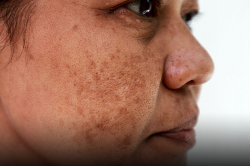 O que é melasma​ e como tratar o melasma no rosto? Confira