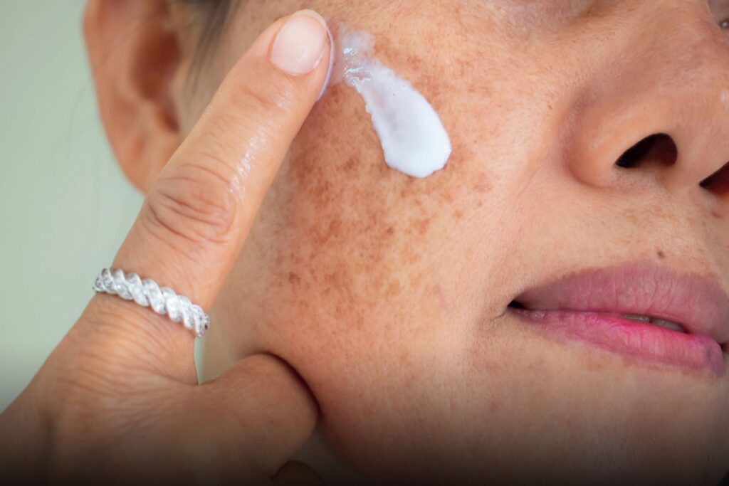 Como tratar o Melasma no rosto​: Passo a passo 