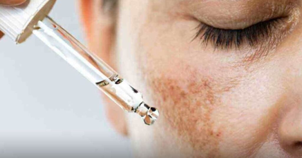 Melhor sérum da para manchas de melasma: Confira os 5 melhores