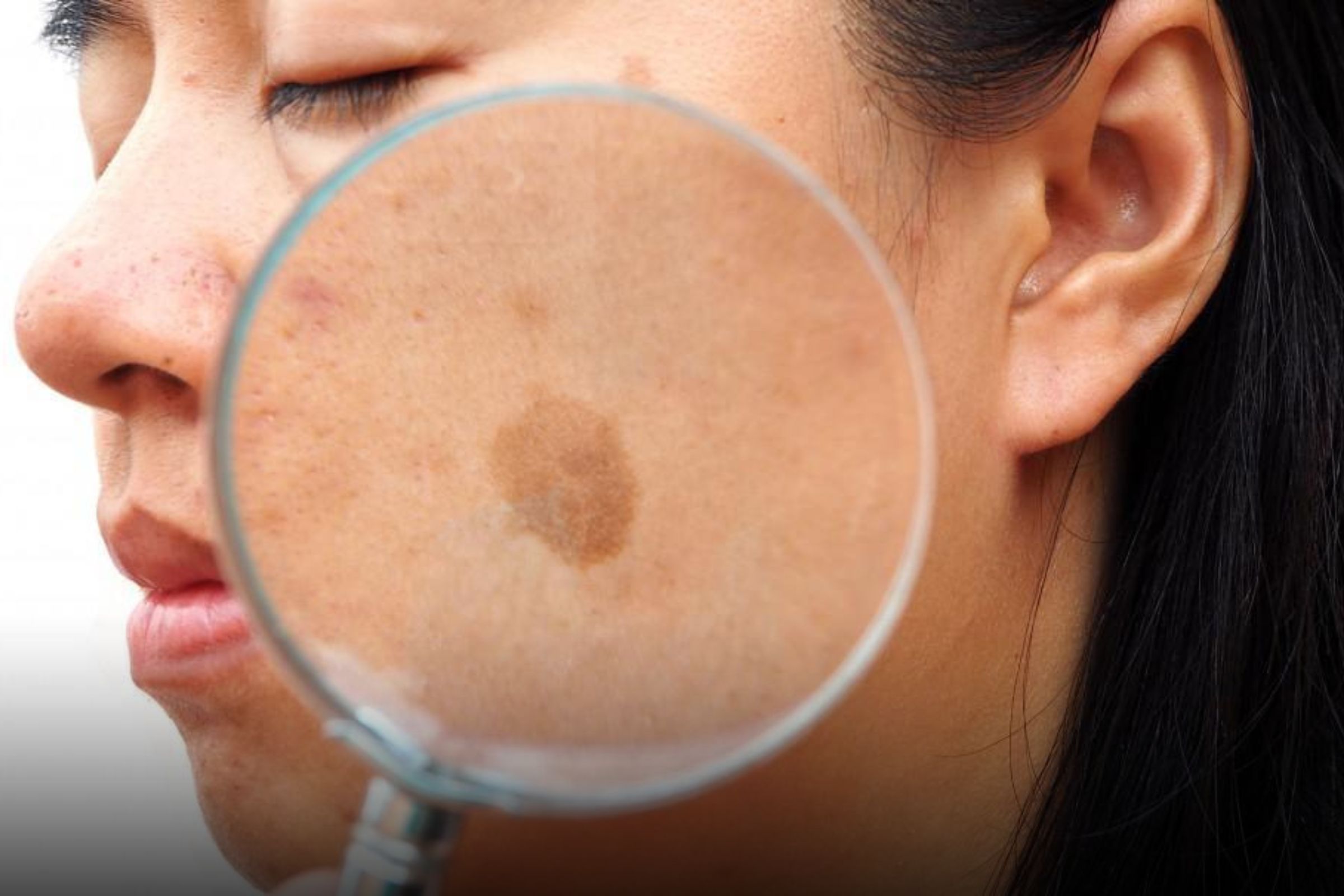 Veja 5 procedimentos que estão ajudando pessoas a se livrar das manchas na pele