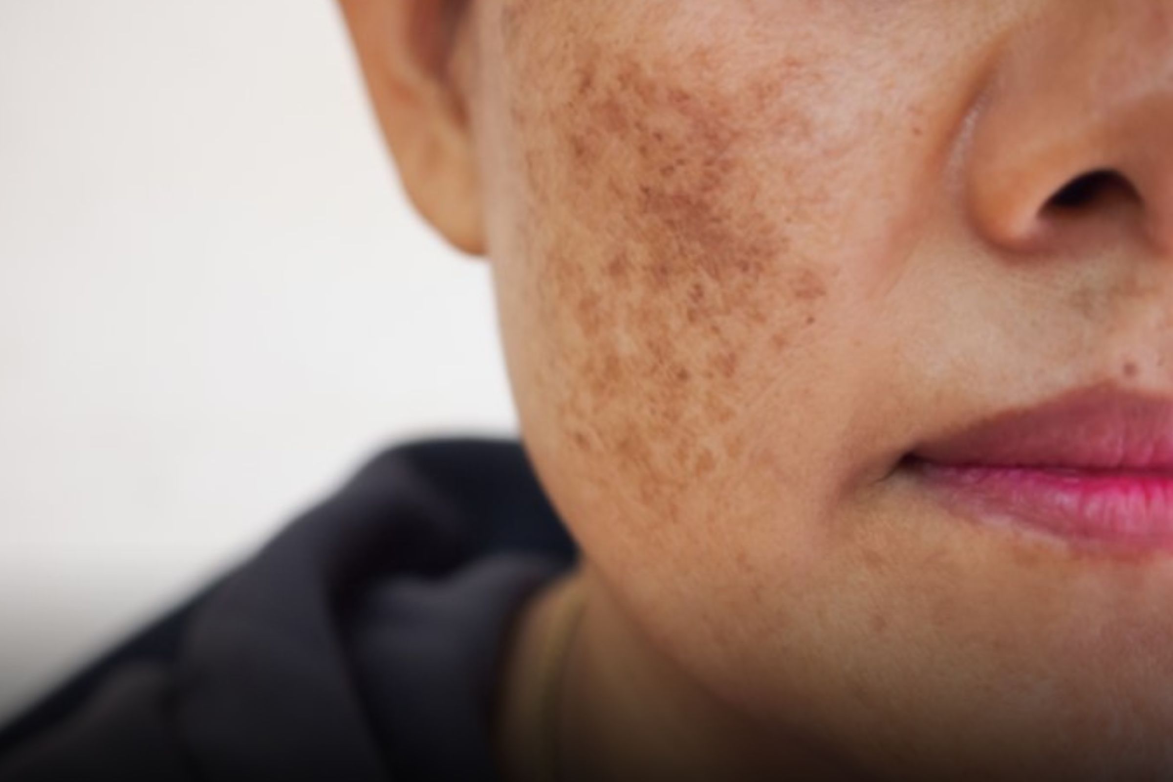 Manchas na pele Melasma: Entenda o Melasma e Saiba Como Evitar e Tratar Esse Problema