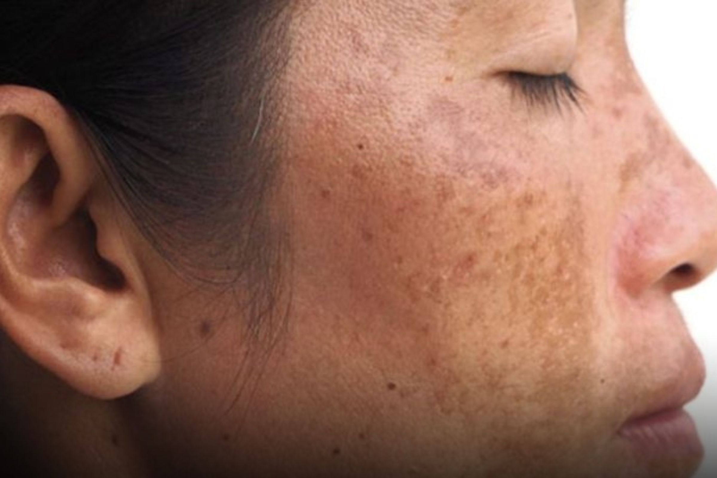 Melasma no rosto: Confira o passo a passo para clarear melasma no rosto