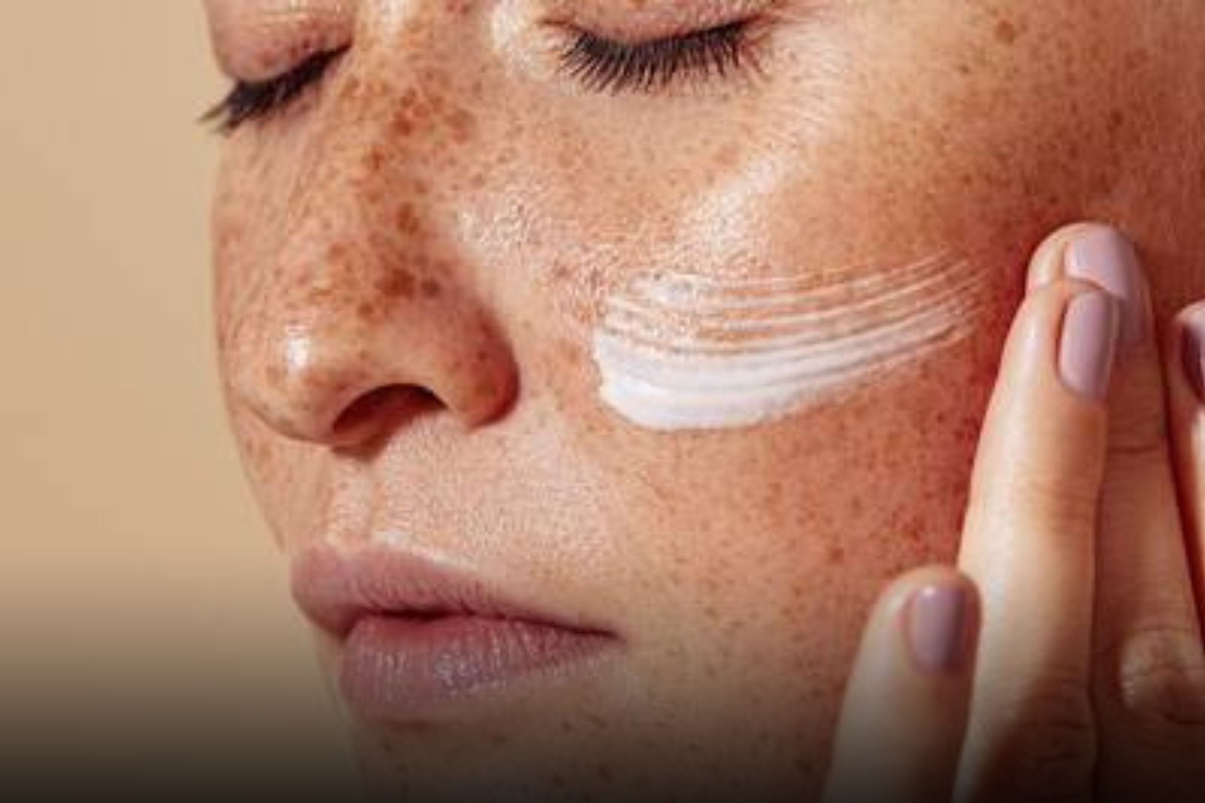 Como tratar o Melasma no rosto​: Passo a passo