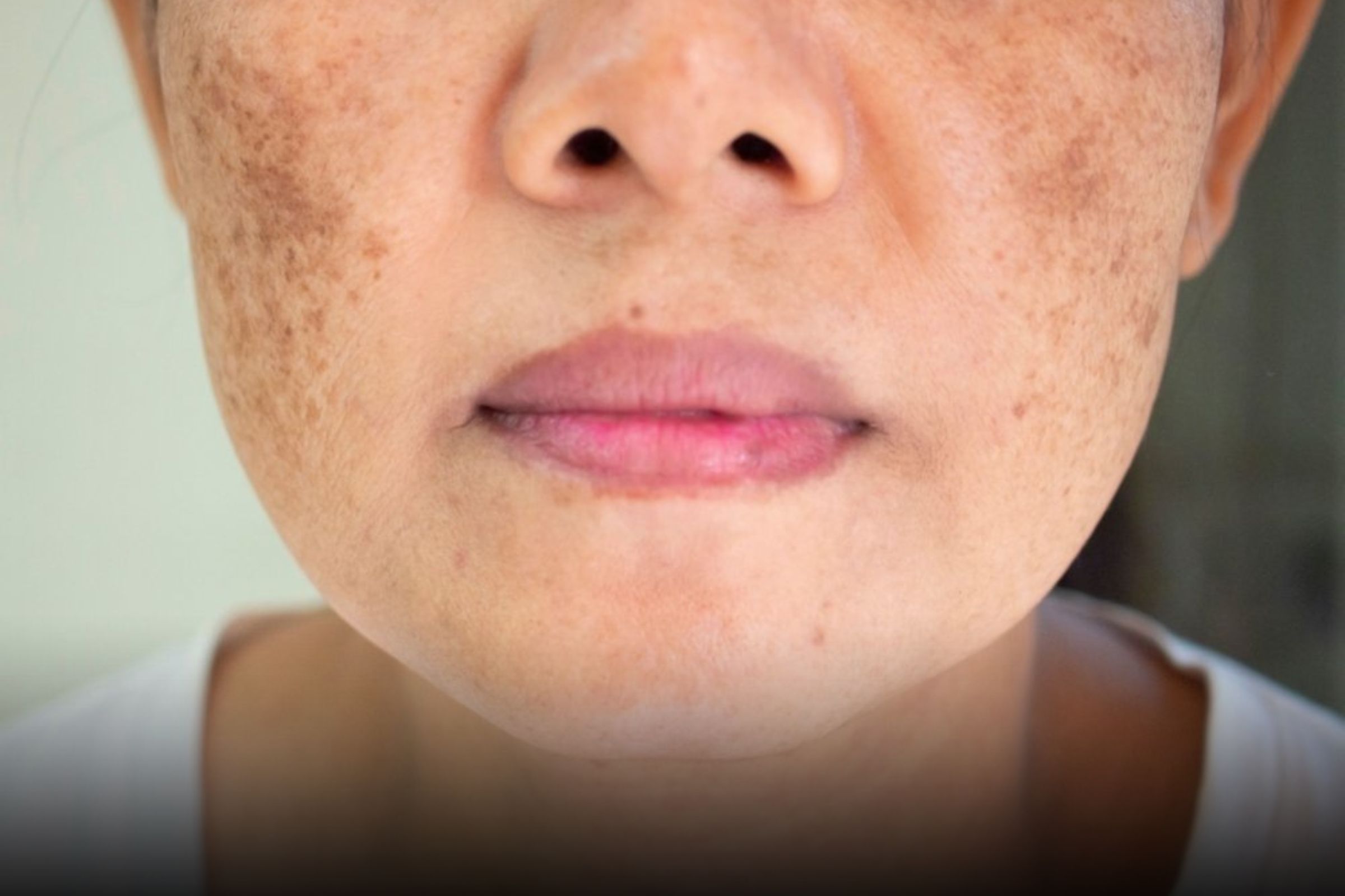 O que é melasma​ e como tratar o melasma no rosto? Confira